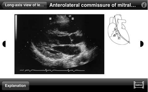 Diagnostic Ultrasound Video Clips #1 Normal Heart screenshot 2