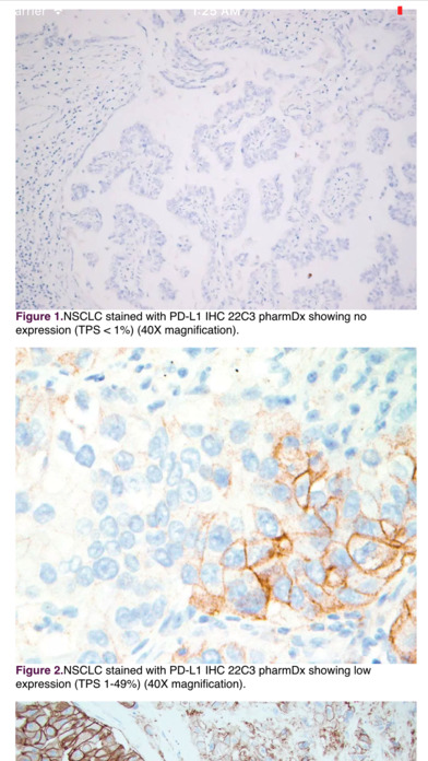 IASLC Atlas of PD-L1 Testing in Lung Cancer screenshot 3