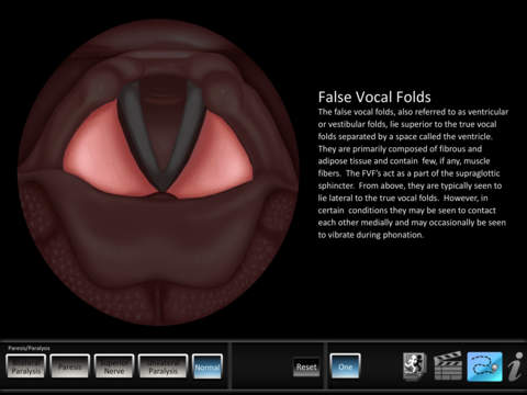 【免費教育App】Vocal Pathology: Paresis/Paralysis-APP點子